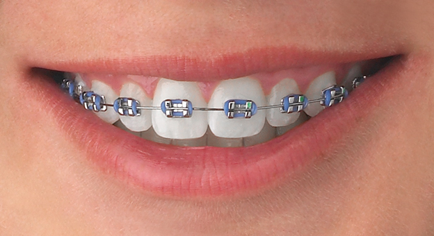 Orthodontic Treatment in South Delhi - 32 Strong