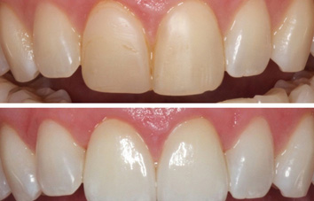 ceramic veneers new delhi