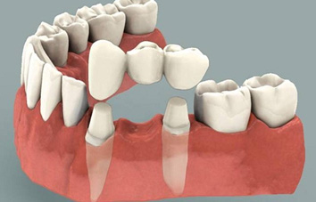 32 Smile Stone Dental Bridge