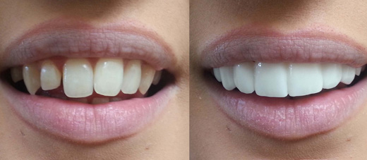 cosmetic dental treatment in delhi