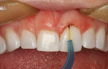 bleeding gum treatment