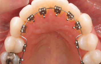 Dental Braces Treatment in Delhi NCR  Orthodontic Treatment Wires and  Braces Delhi