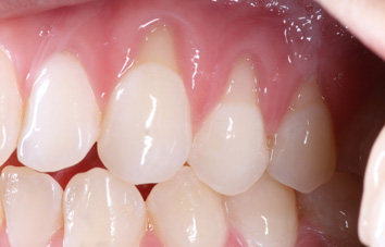 before bledding gum treatment