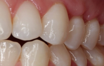 after bledding gum treatment