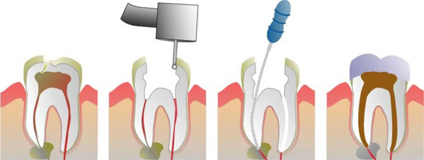 32 Smile Stone Root Canal Treatment