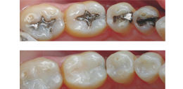 composite tooth white filling