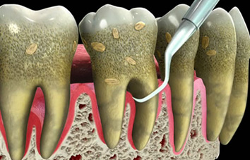 deep teeth cleaning treatment in delhi