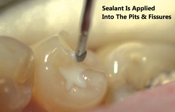 32 Smile Stone Sealants