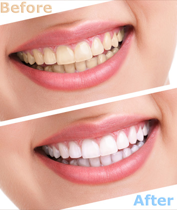 teeth whitening in Delhi