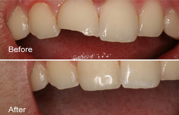 composite filling cost