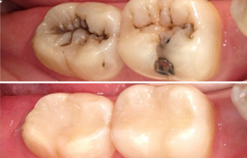 tooth filling cost in delhi