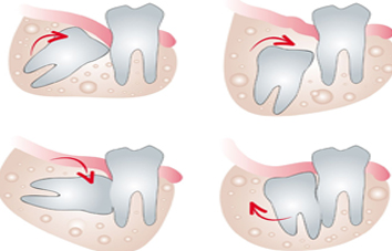 wisdom tooth removal cost