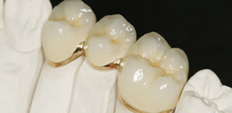 dental crown treatment delhi